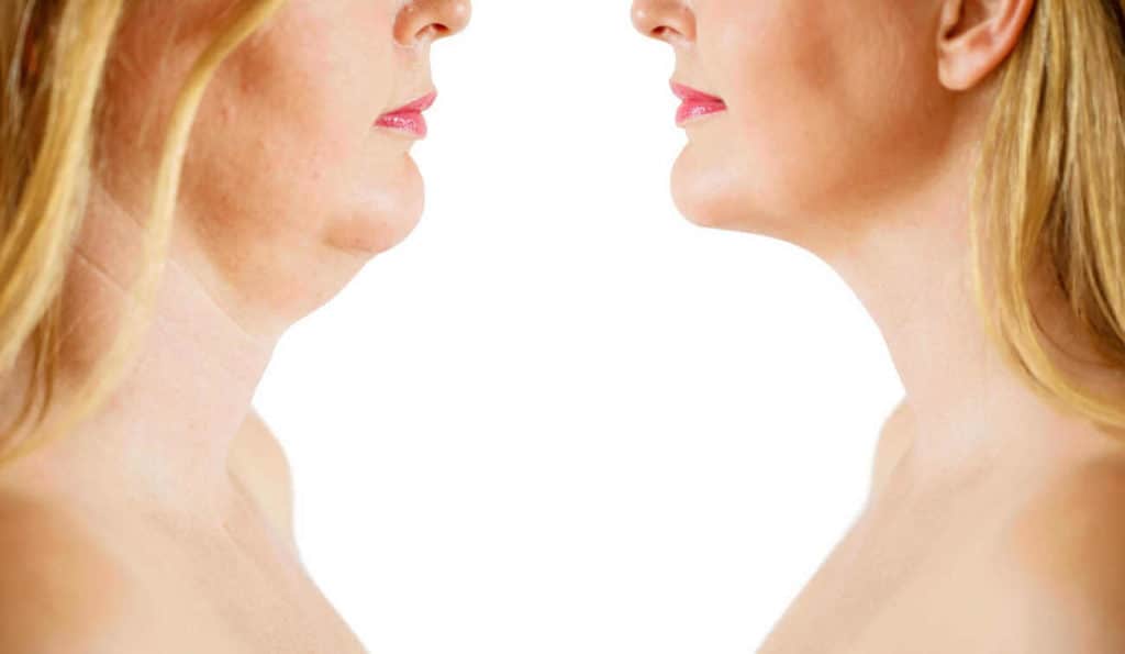 Double Chin treatment Greater London (Croydon) before and after results