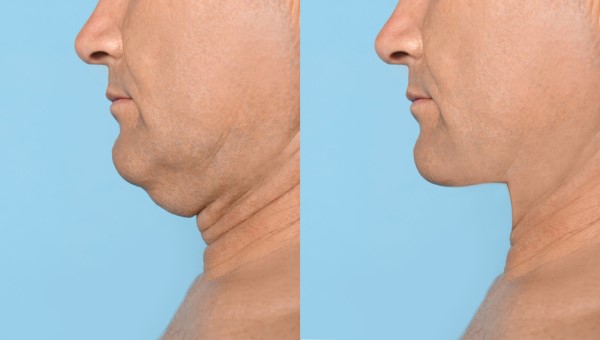 Which Non-Surgical Treatments Work Best for Jowls and Loose Skin Greater London (Croydon)?