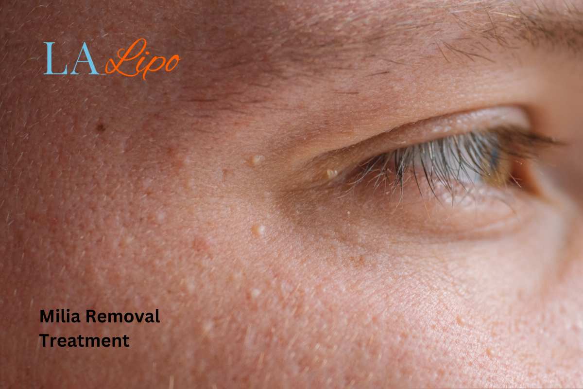 Cryopen Milia Removal: Is It the Easiest and Safest Option Greater London (Croydon)?