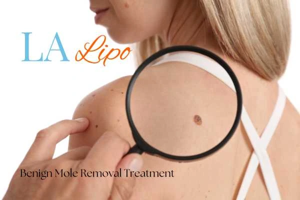 Why getting moles removed Greater London (Croydon) can boost your confidence!