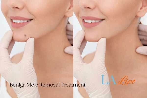 Woman's before and after results of being moles removal treatment Greater London (Croydon)