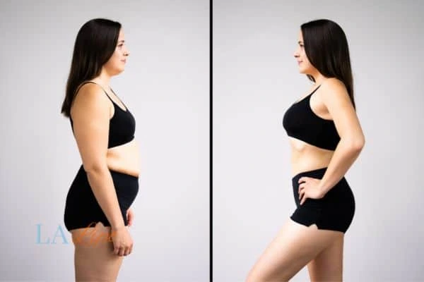 image of woman before and after results of LA-EMS Body Sculpting Greater London (Croydon) to help treat Diastasis recti