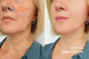 hi-fu for wrinkles Greater London (Croydon) before and after results