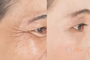 Before and after results of woman - HI-fu wrinkles reduction treatment Greater London (Croydon)