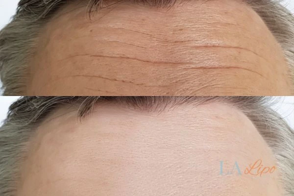 results of HIFU Greater London (Croydon) on mans forehead to help reduce lines and wrinkles