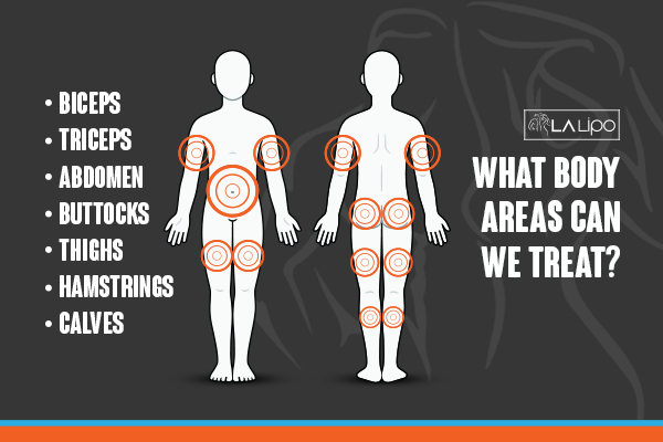 Graphic to show areas you can have LA-EMS Body Sculpting Greater London (Croydon) treatment.
