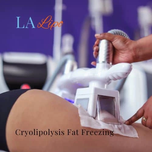 fat freezing - Cryolipolysis Greater London (Croydon)
