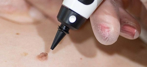 skin tag removal using cryopen Greater London (Croydon)