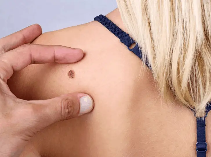 woman having mole removal Greater London (Croydon) consultation before treatment.