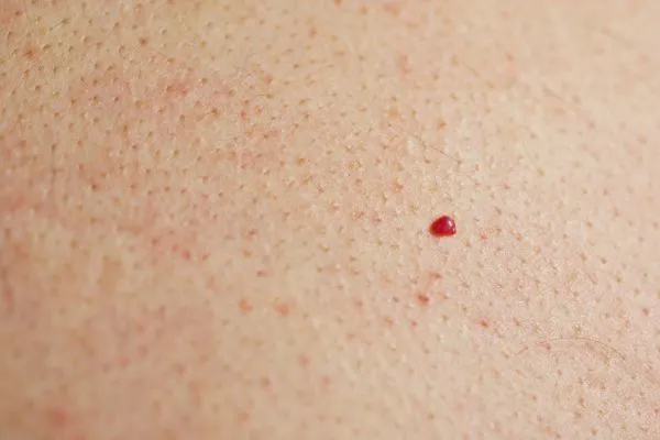 close up of a cherry angioma Greater London (Croydon)