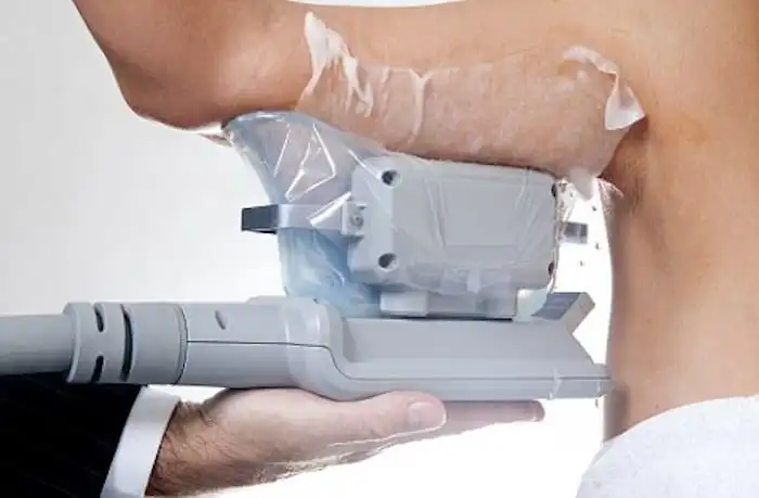 Picture of fat freezing Greater London (Croydon) on the upper arms.