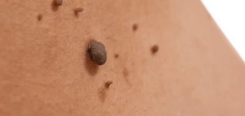 image of a skin tag Greater London (Croydon)