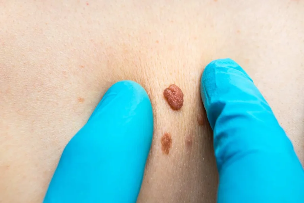 Consultant examining a skin tag Greater London (Croydon)