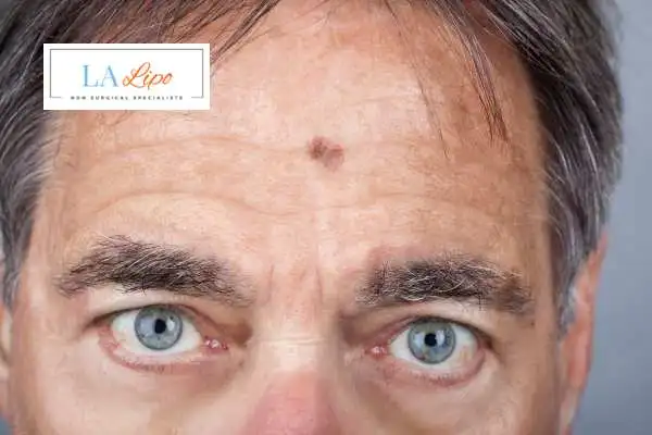 Solar Lentigo Removal Greater London (Croydon) image of man with mark on his forehead