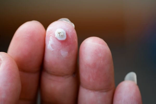 wart on person finger - cryotherapy to treat from LA LIPO Greater London (Croydon)