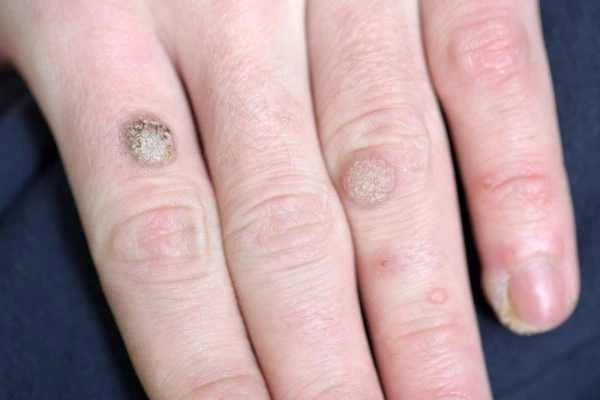 photo of warts on person hand - see wart removal Greater London (Croydon) from LA LIPO