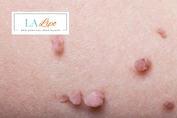 Does cryopen skin tag removal Greater London (Croydon) hurt? Find out now call our team today!