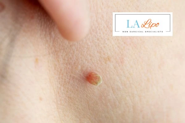 Book skin tag removal Greater London (Croydon) today speak to our team now!