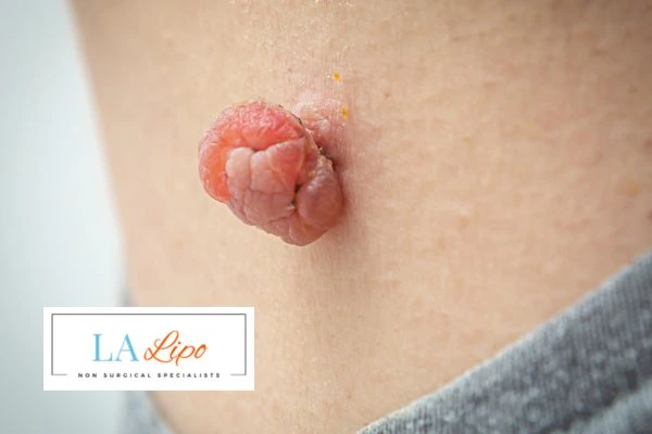 Interested in skin tag removal Greater London (Croydon)? Concerned about the pain? Find out more today!