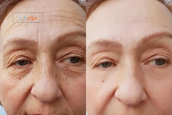 The powerful benefits of Morpheus8 Treatment Greater London (Croydon) - Call Our team today!