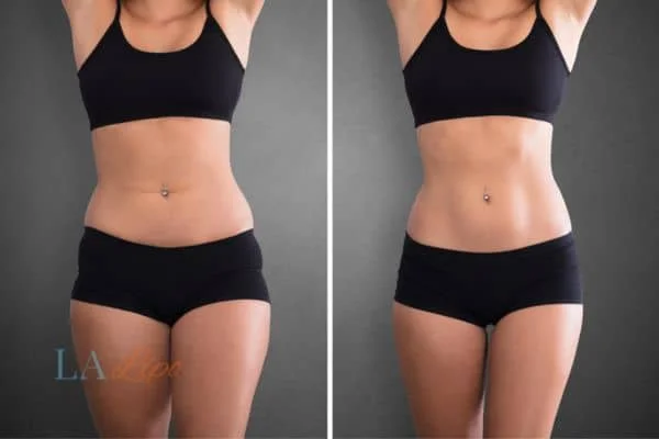before and after results of non-surgical treatment to help a woman's body image and mental health Greater London (Croydon)