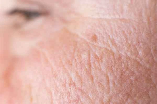 close up picture of a woman's face showing an age spot Greater London (Croydon)