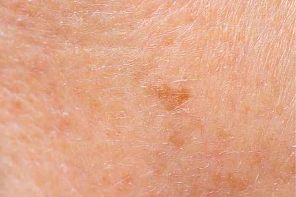 close up picture of age spots Greater London (Croydon)