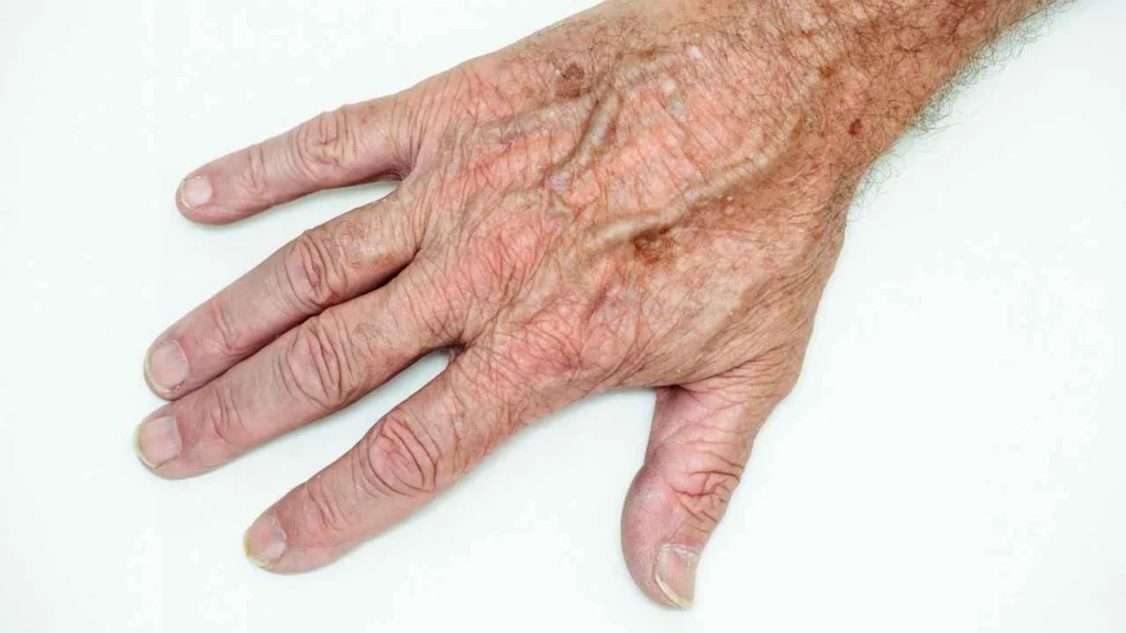 Male hand showing age spot Greater London (Croydon)