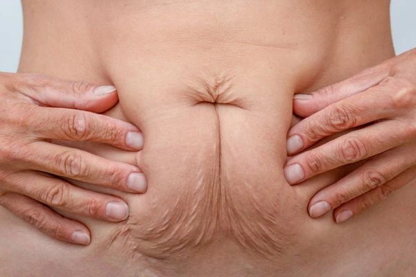 Image of a woman's stomach with loose skin - example of skin tightening Greater London (Croydon) options