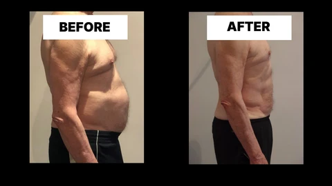 What Symptoms Can Diastasis Recti Cause in Men? Weak Core, Back Pain and Poor Posture Greater London (Croydon)